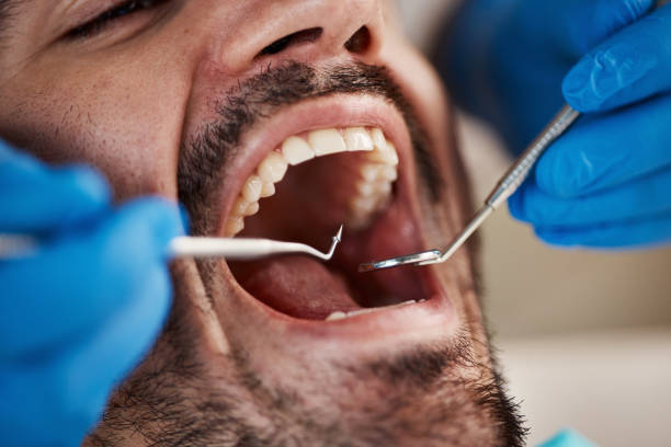 Best Emergency Dentist for Lost Fillings or Crowns in Greenwood, DE